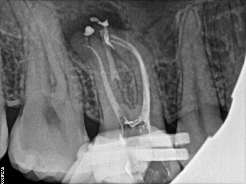 Fig. 45: Post-op radiograph.