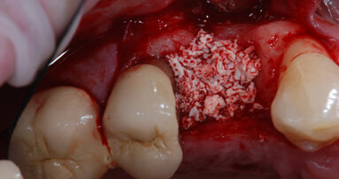 La gestione dell’alveolo estrattivo nel trattamento implantare alla luce delle più recenti acquisizioni