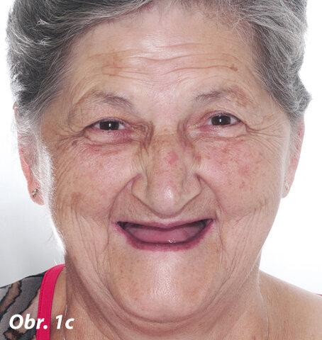 Pacientka požadující okamžité a finančně dostupné ošetření bezzubé horní a dolní čelisti