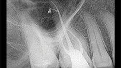 Efekat primene parcijalnog vakuuma na hemijsku obradu sistema kanala korena: Sleimanova faza