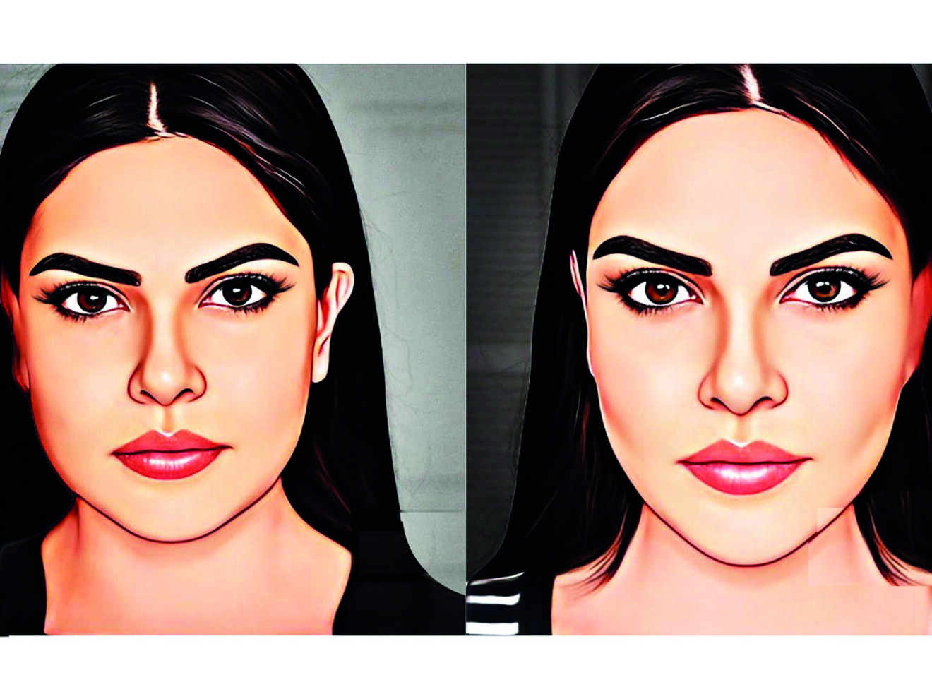 Fig. 3 : Situation pré et postopératoire.