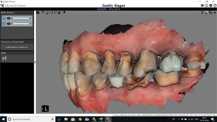 Fig 11: Pre-operative intraoral scans of the patient with severe mutilation of teeth