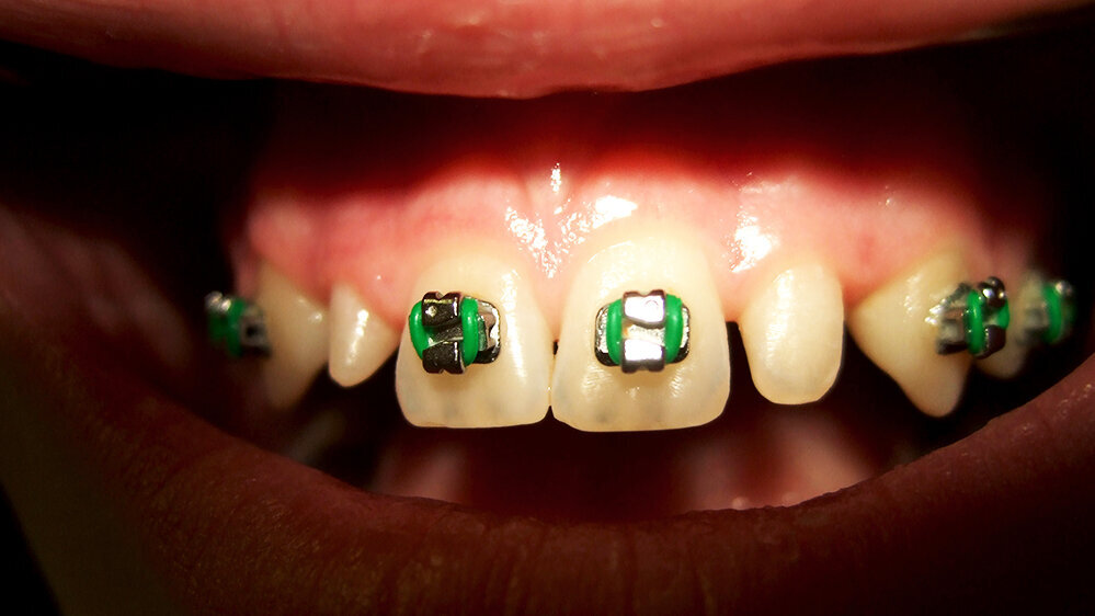 Direct composite restorations in orthodontic indications