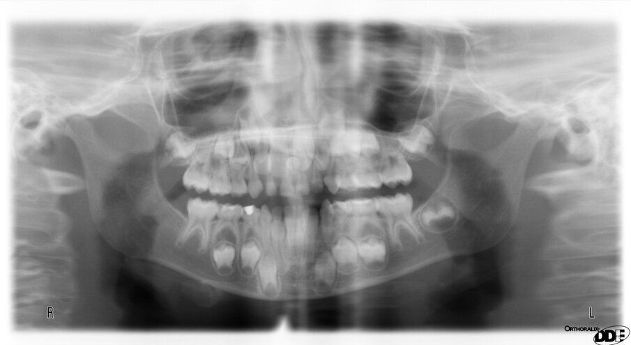 Fig. 2. A previously taken DPT of 8 ½ year old (LT) when she was 7 showed the presence of a supernumerary tooth ($) (arrow) in the maxillary midline. This was accidently omitted at the time indicating the importance of a comprehensive report every time an x-ray is taken.