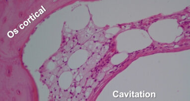 Échographie transalvéolaire dans le diagnostic des lésions inflammatoires de l’os