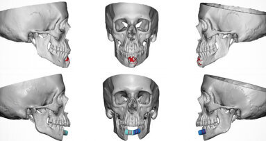 Jaw-in-a-day surgery successfully performed for the first time in Alabama