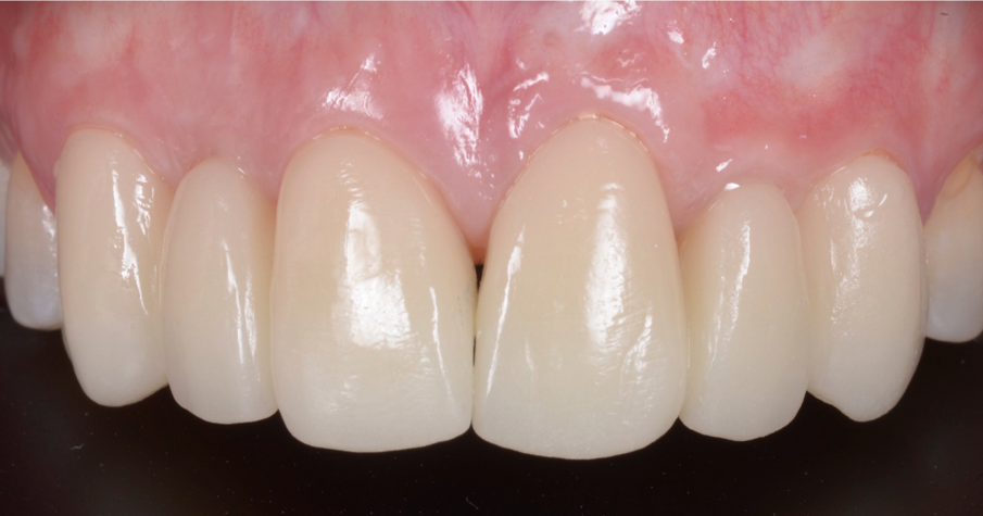 Fig. 16_Provvisorio in situ dopo chirurgia mucogengivale.