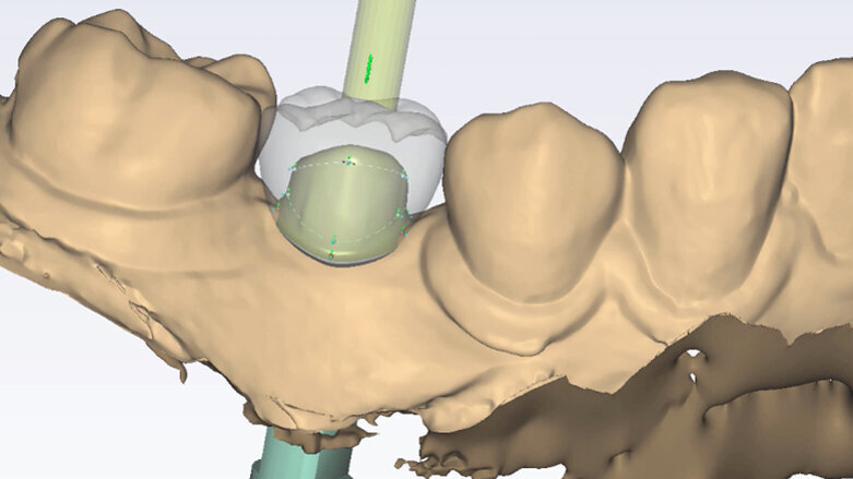 Řízená implantologie za použití řešení Planmeca all-in-one