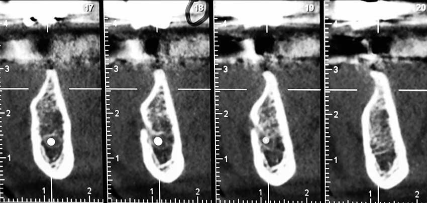 Fig. 1c - CBCT iniziale.