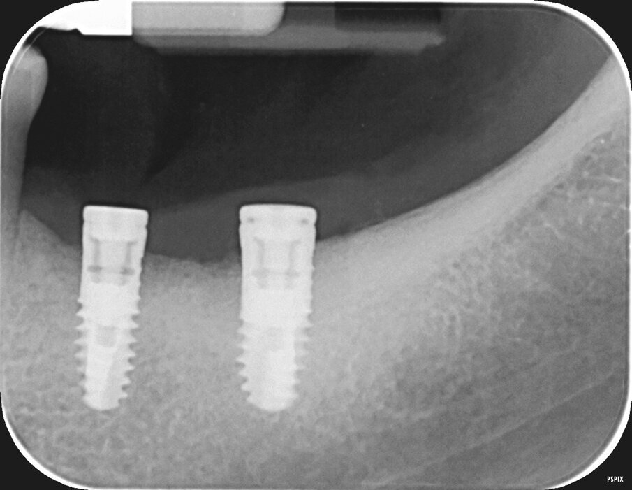Fig. 9- Radiografia endorale di controllo al termine dell’intervento.