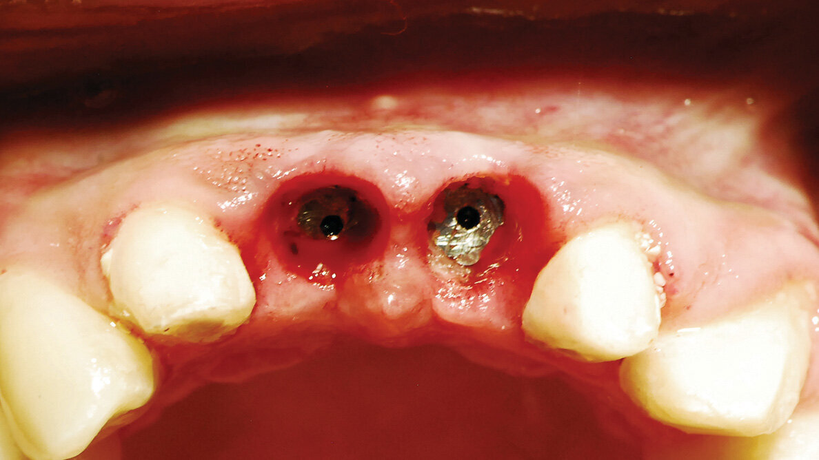 Predictable implant uncovery with diode laser