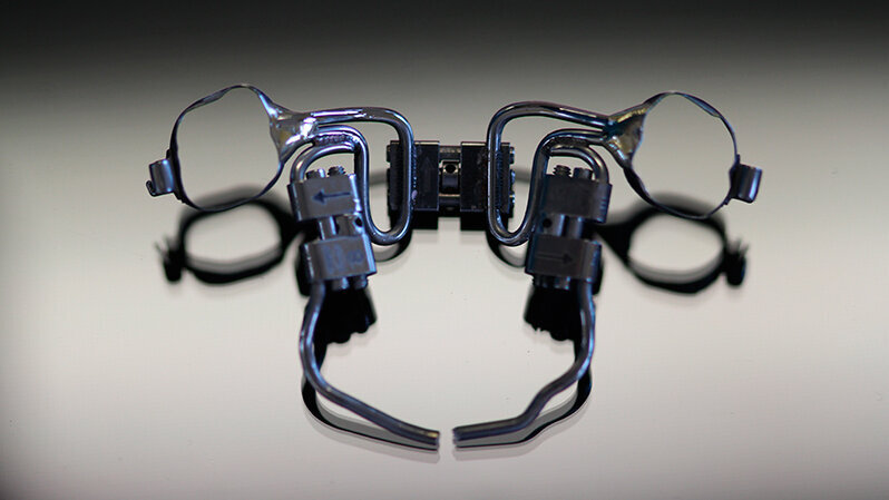 Il TSME (Transverse Sagittal Maxillary Expander) per il controllo tridimensionale del mascellare superiore