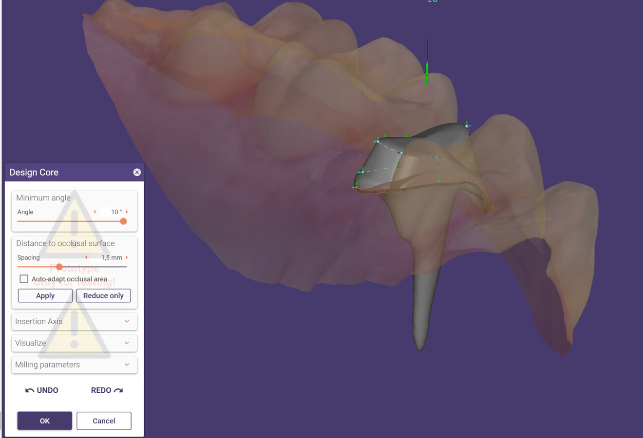 The new Preparation Margin Repair tool enables users to fix margins to get an acceptable result despite artefacts or holes in the scan.
