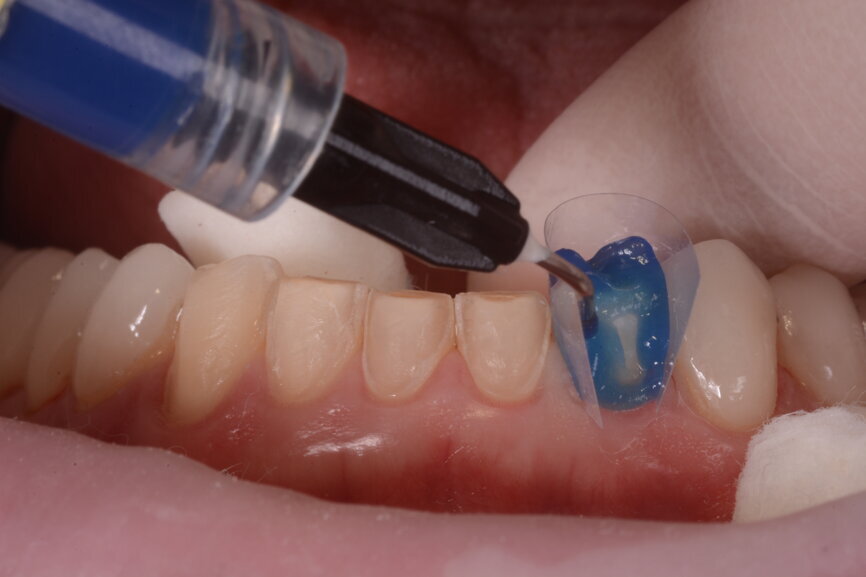 Fig. 11: The crowns (#11–13 and 21–23) and veneers (#14–17, 24–27, 31–37 and 41–47) were secured to the abutments using a light-cured resin adhesive (Futurabond U and Bifix QM).