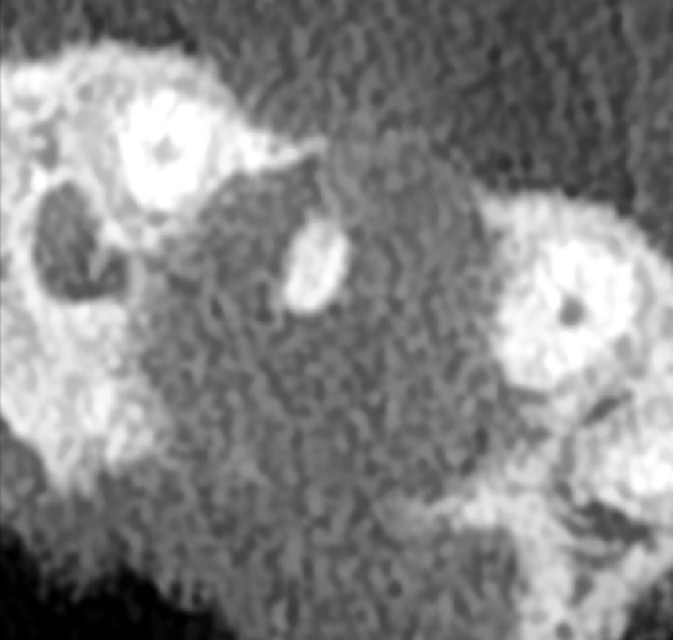 Fig. 2a: CBCT images showing the size of the lesion and destruction of both cortical walls. Artificial intelligence-enhanced image.