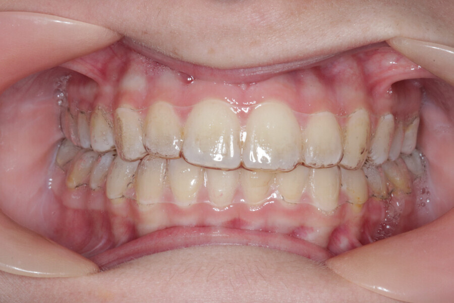 Fig. 17: Aligner #22.