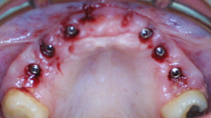 Quick and easy prosthetic planning Quick and easy prosthetic planning