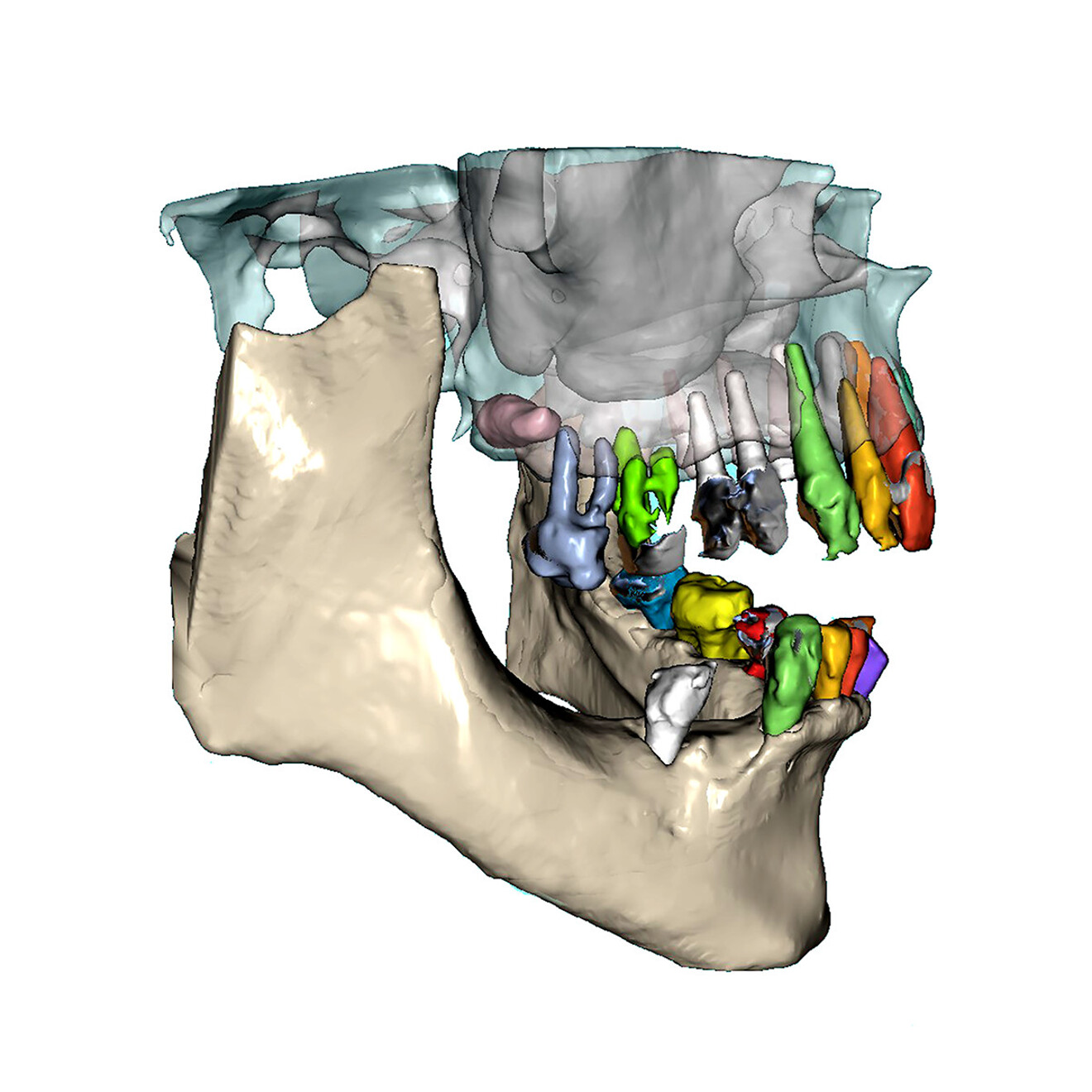 Fig. 5a: Views of AI-assisted bone and tooth segmentation of the maxillary arch used for diagnosis, treatment planning and surgical guide design. Right lateral view.