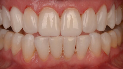 Flowable injection technique—a composite revolution with CLEARFIL MAJESTY ES Flow Low