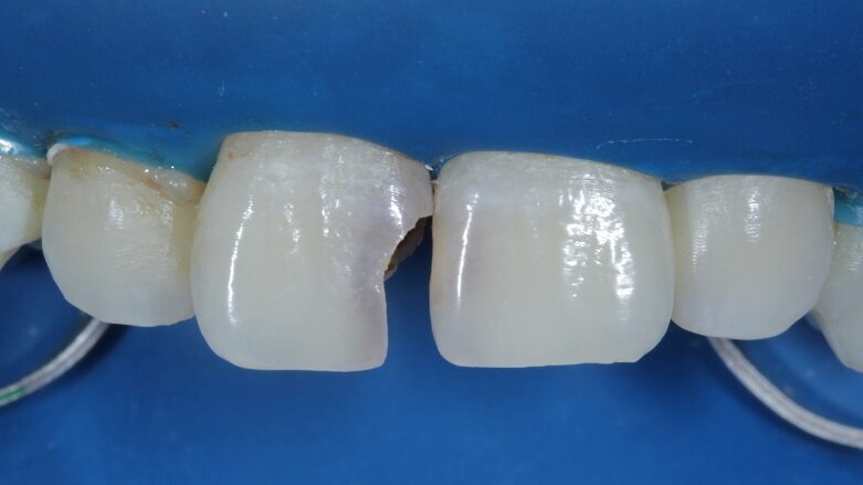 Fig 6: Isolation under a rubber dam