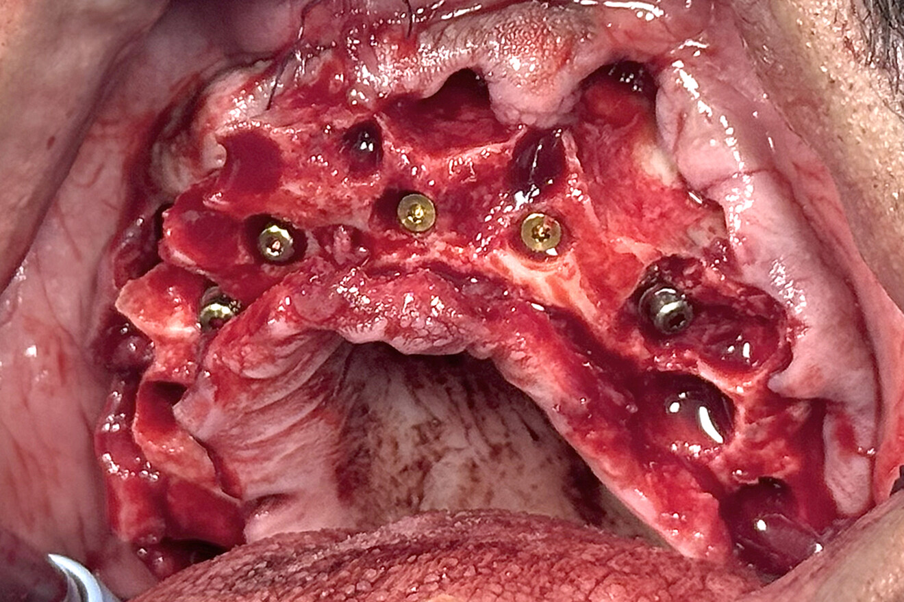 Fig. 12: Retracted intra-oral view of the maxillary Neobiotech implants positioned as planned, revealing residual extraction sockets and buccal bony cavities.