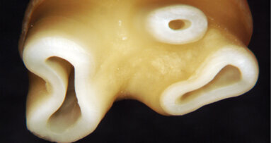 Minimally invasive and biomimetic endodontics: The final evolution?