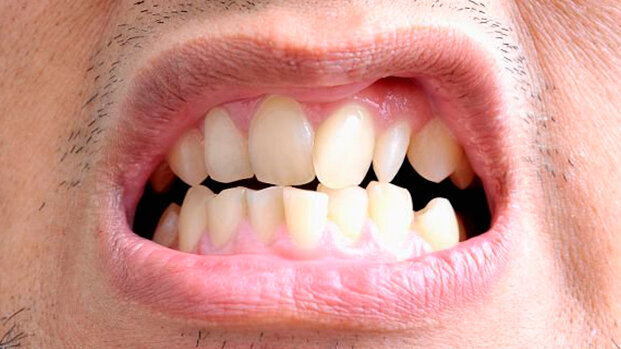 La malocclusione associata a problemi posturali e di equilibrio