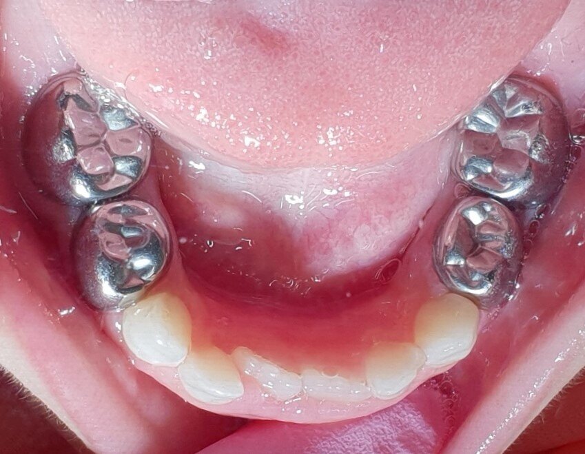 Afbeelding 4b: Kleurfoto’s op de leeftijd van 6 jaar, juli 2018. Alle cariëslaesies in de bovenkaak zijn arrested, in de 55, 64 en 65 met ondersteuning van SDF. Laesies die tijdens het aanbrengen arrested waren, zijn niet verkleurd.