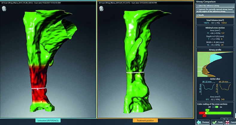 Comparison of the upper airways in habitual and therapeutic positions of the lower jaw.