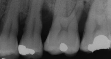 Utilizzo del laser a diodo associato  alla strumentazione parodontale non chirurgica come trattamento alternativo e nella gestione di infiammazioni recidive