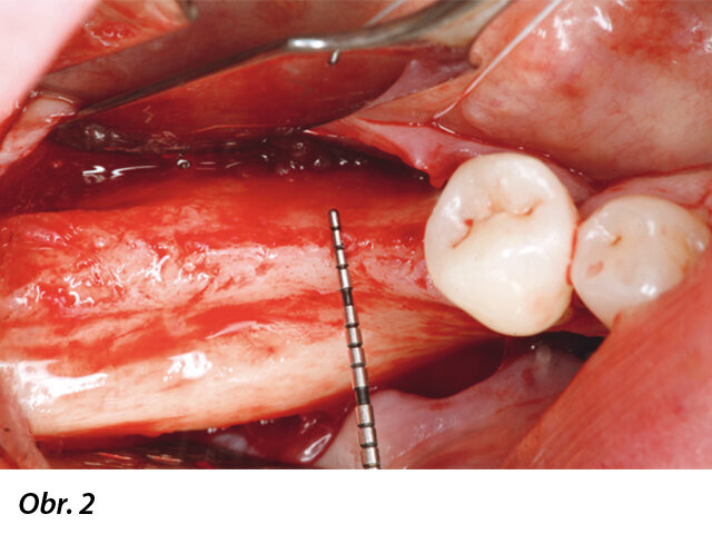 Okluzální pohled na tenký hřeben v distální části dolní čelisti. V oblasti keratinizované gingivy na středu hřebenu byl proveden mukoperiostální řez. Pro zajištění chirurgického přístupu byly provedeny dva rozbíhavé vertikální řezy, jeden meziobukálně od prvního premoláru a jeden šikmý vertikální řez na nejdistálnější straně krestálního řezu.
