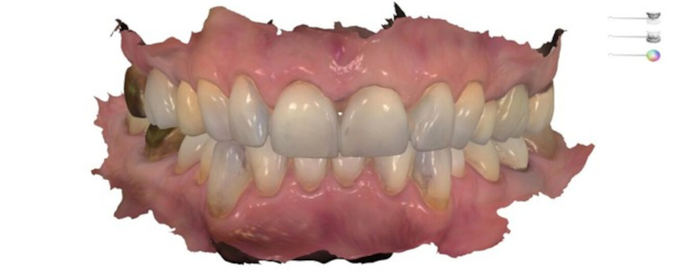 Fig. 3: Intra-oral scan taken with the TRIOS (3Shape).