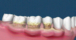 Les cancers de la tête et du cou peuvent résulter d’une parodontite