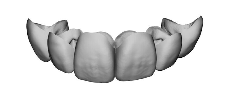 Fig. 20. Mock-up virtual creado por el técnico dental sin hacer un encerado.