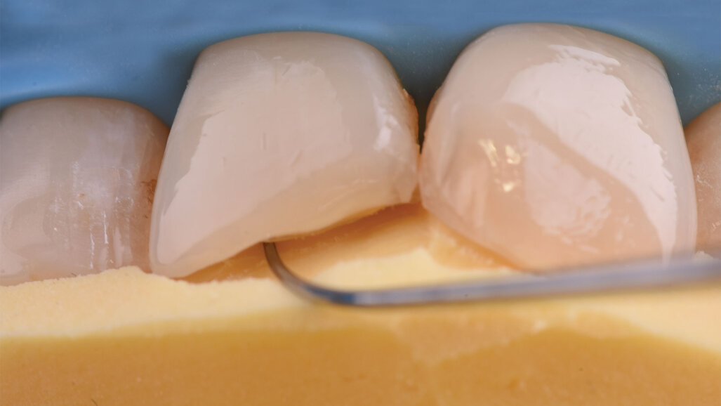 Life-Like IV klasa u dve kompozitne mase