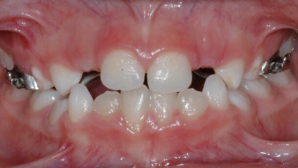 Problemi trasversali: espansione rapida oppure lenta del mascellare?