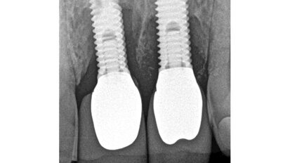 Terapie periimplantitidy při použití resorbovatelného, náhradního kostního materiálu
