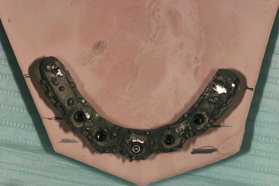 Fig. 3. Barra de Duralay® OSU, modelo rígido donde se fabrica la barra y barra metálica colada.