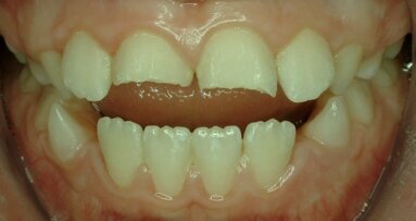 שכיחות חבלות בשיניים בעולם