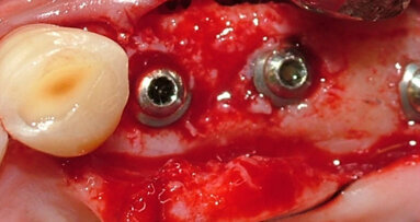 Riabilitazione implanto-protesica in un caso di grave atrofia ossea al mascellare superiore risolto mediante l'utilizzo di short implants