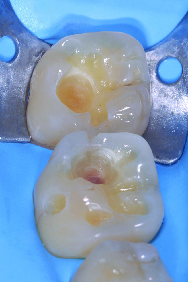 Figg. 2-5_Rimozione dei vecchi restauri presenti su 4.6 e 4.7: gli elementi vengono restaurati con tecnica diretta utilizzando dentina e smalto Enamel Plus HRI Bio Function. 