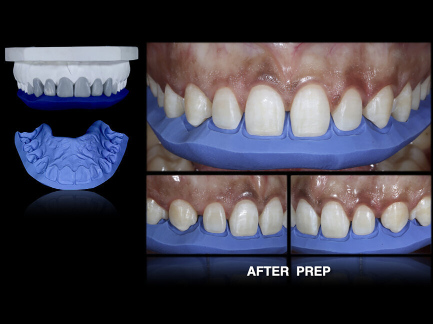 Fig. 54: The palatal-incisal
silicone index was used to establish the space on the incisal margin. Steps before, during and after preparation.