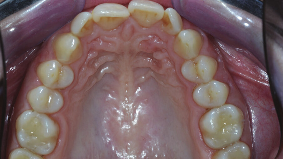 Figg. 4g, 4h_Foto occlusali di inizio trattamento.