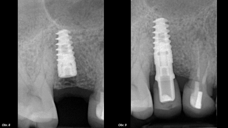 Obr. 8: RTG snímek pořízený bezprostředně po zákroku. Obr. 9: RTG snímek pořízený po osmi měsících zatížení.
