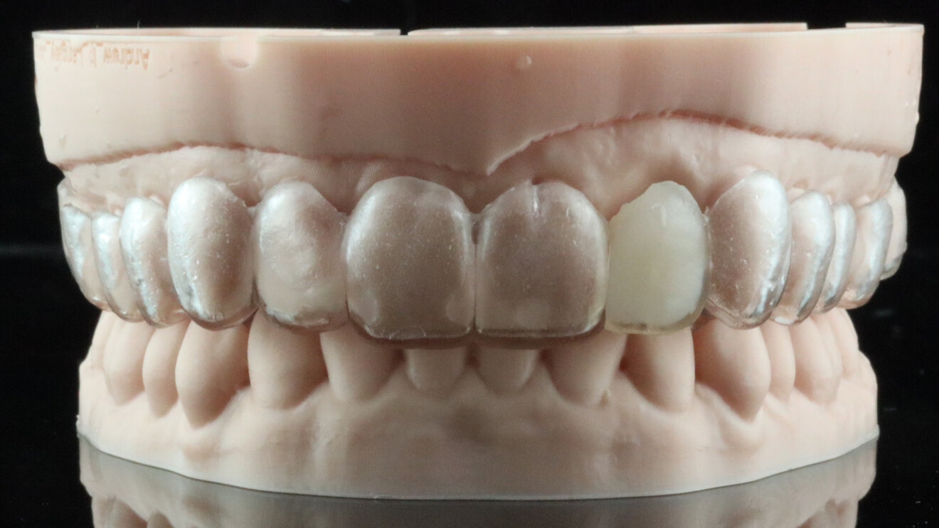 Fig. 6b: Final provisional retainer checked on a model to confirm the fit.