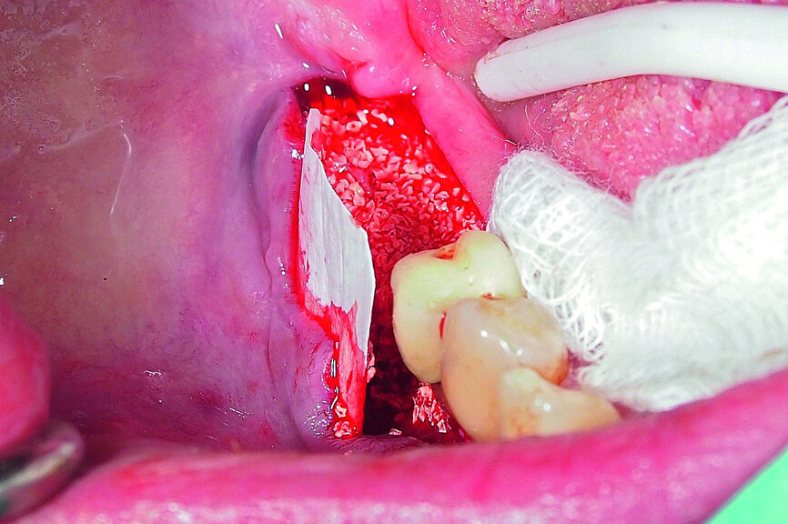 Fig. 19: Bone defect filled with xenograft and covered with an absorbable collagenous membrane.