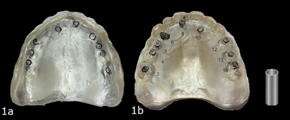 Figs. 1a & b: Clear duplicate denture with the proposed sites outlined on the interior of the denture and guide holes created (a) and with 2 mm guided sleeves pressed into the holes (b). Sites: maxillary right second premolar, right first premolar, right canine, right central incisor, left lateral incisor, left first premolar and left second premolar.