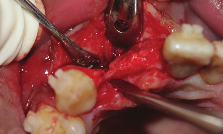 Figure 12: Preoperative view showing the amount of horizontal bone deficiency in the area.