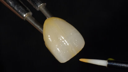 Caracterización de una restauración de cerámica híbrida