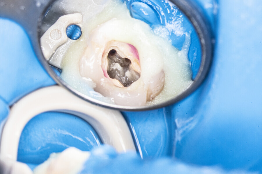 Fig. 58: View of the pulp chamber, showing the MB1 and MB2 canals joined in the medial part.